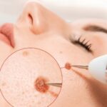 Understanding the Risks and Benefits of Moles Removal Procedures