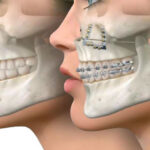 How Does Maxillofacial Surgery Interact with Dental and Orthodontic Treatments?