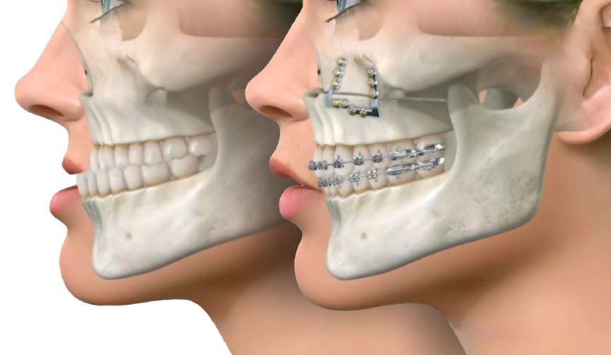 How Does Maxillofacial Surgery Interact with Dental and Orthodontic Treatments?