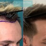 When Is the Right Time to Get a Hair Transplant? 3 When Is the Right Time to Get a Hair Transplant?