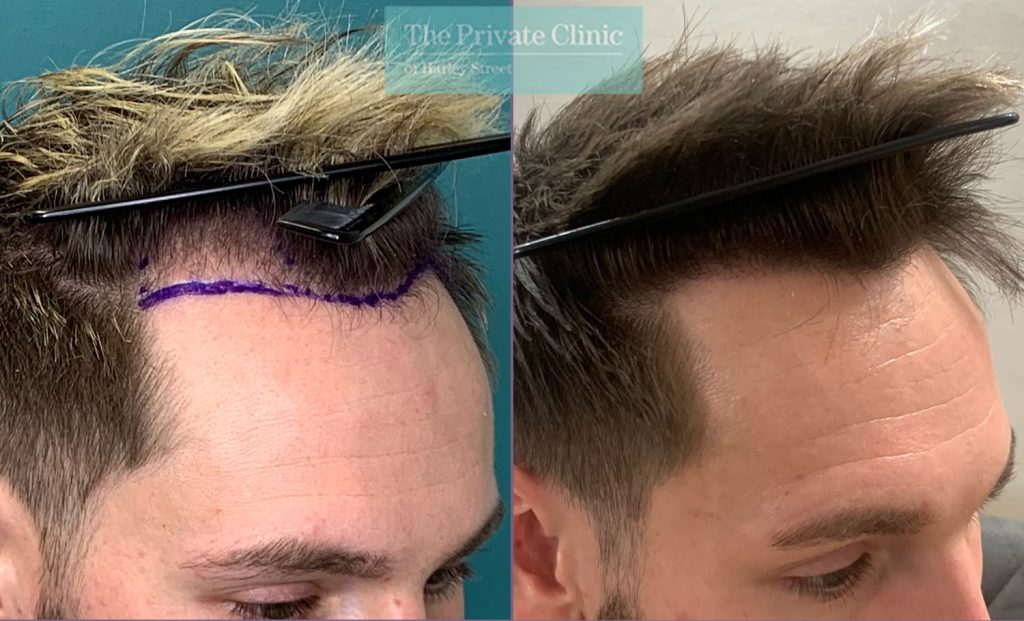 When Is the Right Time to Get a Hair Transplant?