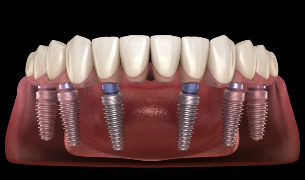 Comprehensive Guide to All-on-6 Dental Implants: What to Expect