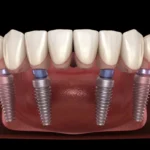Comprehensive Guide to All-on-6 Dental Implants: What to Expect