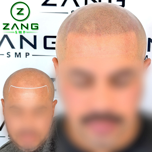 SMP in Los Angeles: A Modern Solution for Hair Loss