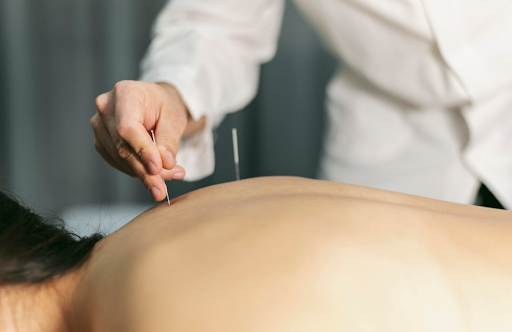 Restorative Paths Through Acupuncture Services in New York