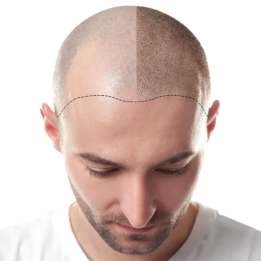 Restore Confidence with Scalp Micropigmentation: A Modern Cosmetic Solution