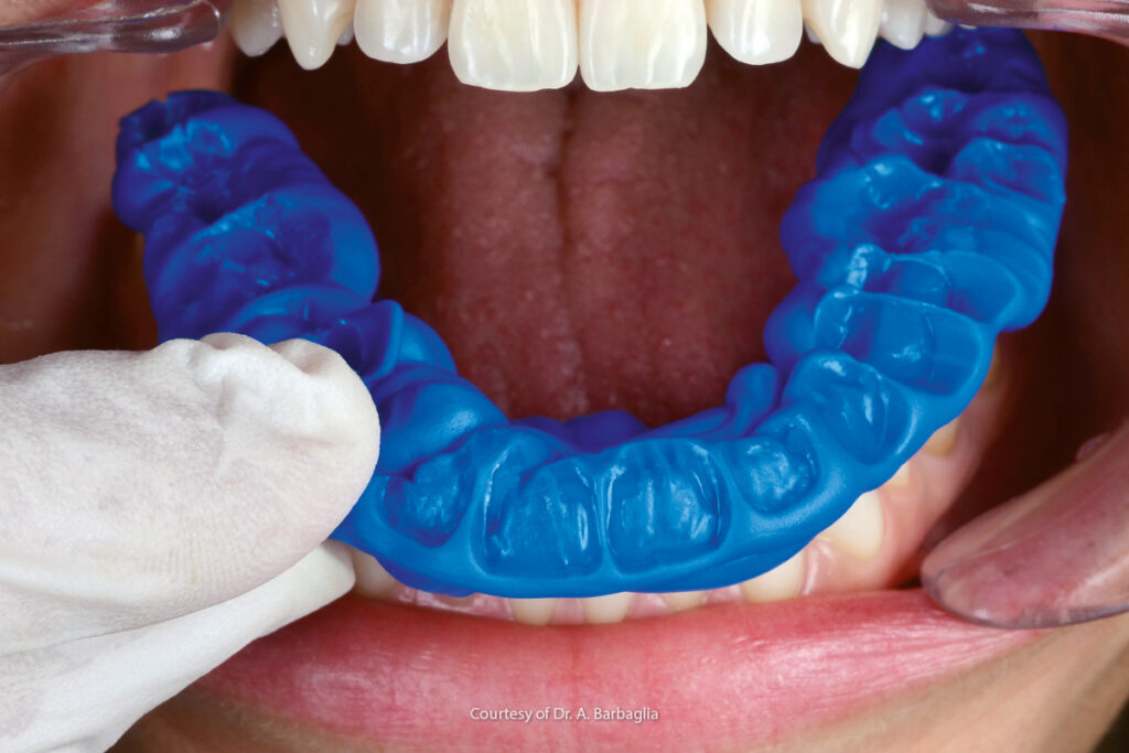 Understanding the Importance of Bite Registration for Optimal Dental Prosthetics 1 Understanding the Importance of Bite Registration for Optimal Dental Prosthetics