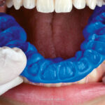 Understanding the Importance of Bite Registration for Optimal Dental Prosthetics