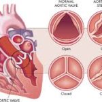 Understanding the symptoms of aortic stenosis: When to consider TAVI
