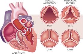 Understanding the symptoms of aortic stenosis: When to consider TAVI